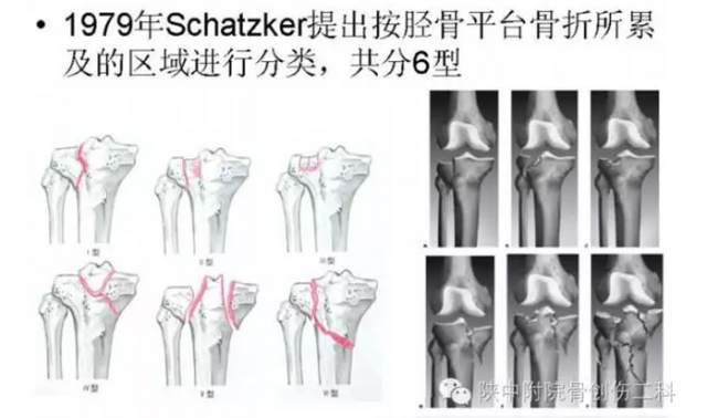 schatzker将胫骨平台骨折分为6型(如示意图)