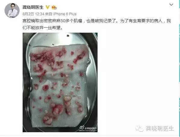 宫腔镜冷刀切除子宫肌瘤有什么优势