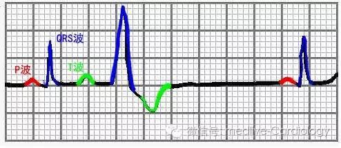 室性早搏:心室异位激动点产生的激动早于正常窦房结的激动,导致心室被