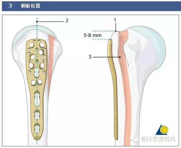 骨科时间:简单方法降低肱骨近端钢板放置难度