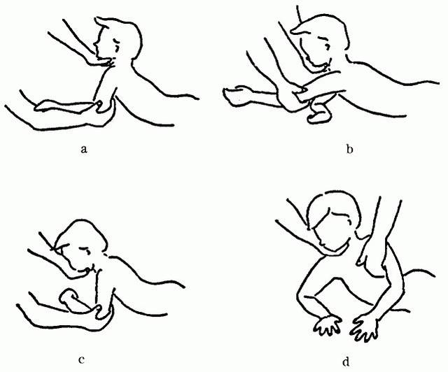 图3—35 紧张性迷路反射阳性患儿卧位训练 a.