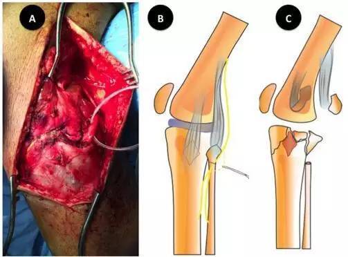 手术技巧:延长后外侧入路治疗劈裂压缩外侧胫骨平台骨折