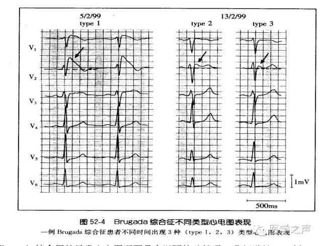 1,i 型具有诊断意义 2,ii,iii 型心电图没有特殊诊断意义 3,当表现为