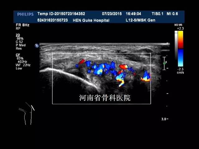 距腓韧带撕裂 我院郑州院区功能检查科肌肉-骨骼系统超声能够提供较