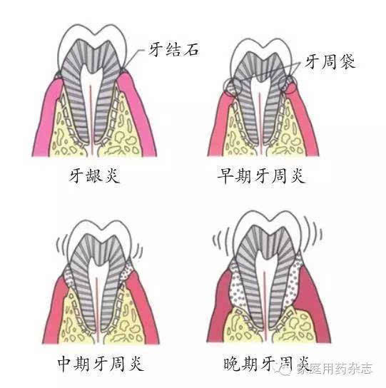 牙龈炎和牙周炎