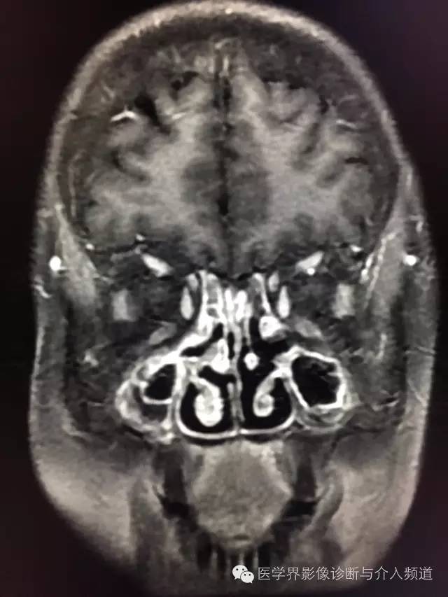 mri可见双侧上颌窦及筛窦炎