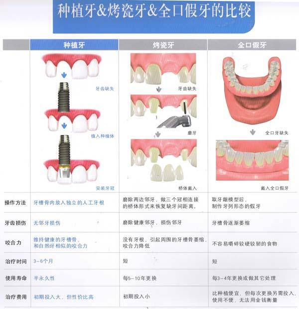 种植牙&烤瓷牙&全口假牙的比较!