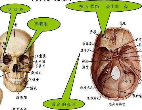 颅骨骨折损伤大脑怎么办?