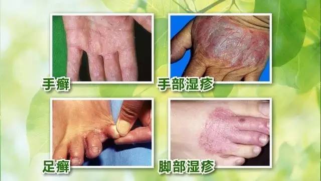 【揭秘】占夏季皮肤科门诊量40%的皮肤病竟是它!