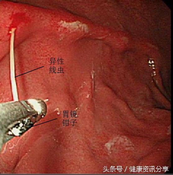 医生从胃里取出了11条虫子,生吃海鲜要小心