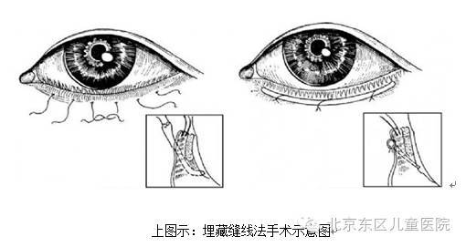 在下眼睑缘做穹窿部结膜到眼睑皮肤的全层缝合,视患儿的具体病情,缝合