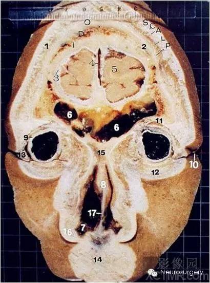 经典颅脑断层解剖图冠状位