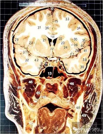 经典颅脑断层解剖图——冠状位