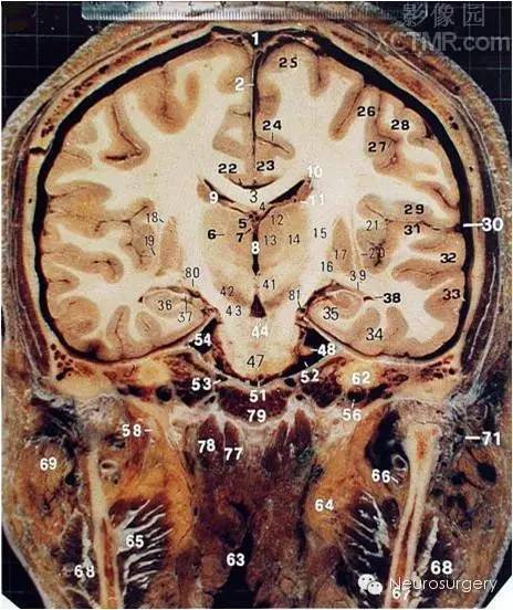 经典颅脑断层解剖图冠状位