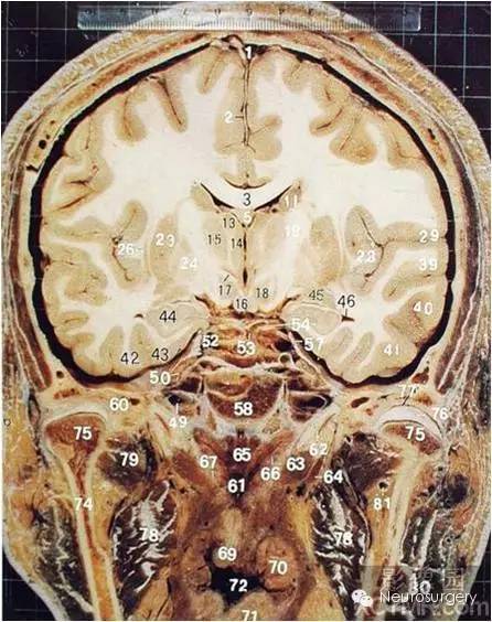 经典颅脑断层解剖图——冠状位