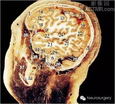 经典颅脑断层解剖图—矢状位