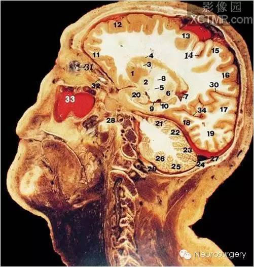 经典颅脑断层解剖图——矢状位