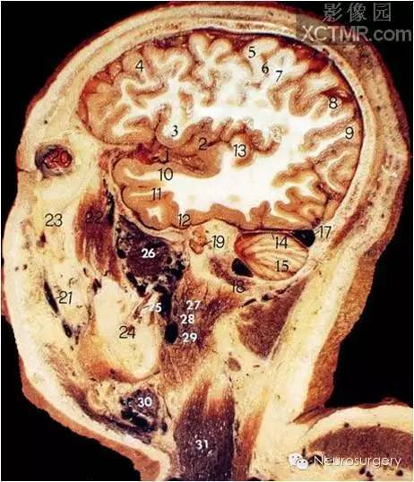 经典颅脑断层解剖图——矢状位