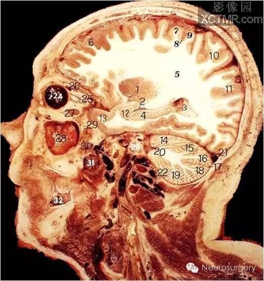 经典颅脑断层解剖图——矢状位