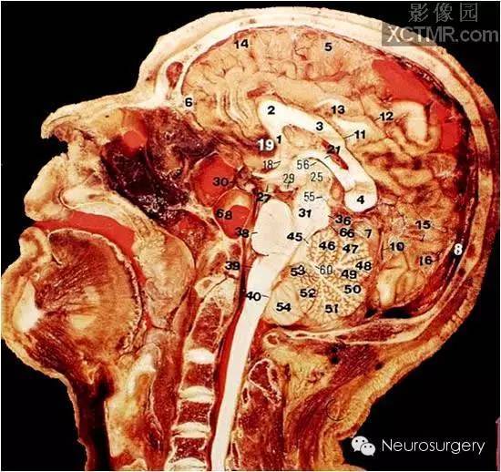 经典颅脑断层解剖图——矢状位