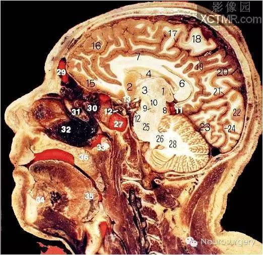 经典颅脑断层解剖图——矢状位