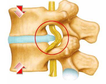 长圆针治疗腰椎间盘突出是什么原理