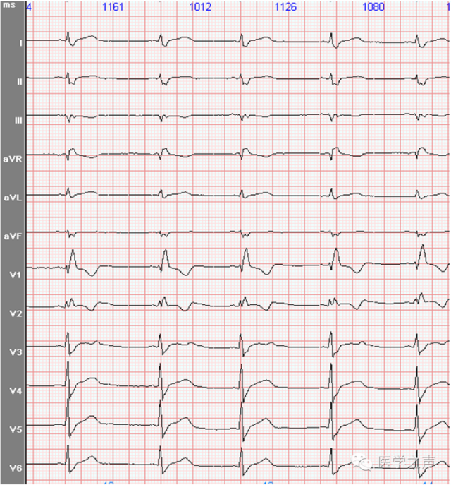 每天学看一份心电图(第29期)完全右束支传导阻滞