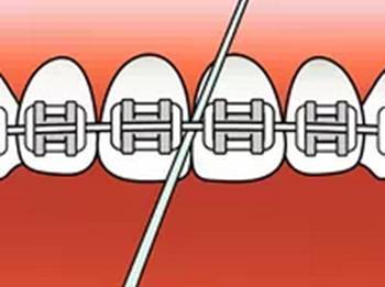 牙齿矫正期间戴着牙套能不能刷牙?