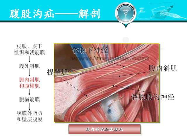 iii:斜疝,内环口大于二指(>4cm),腹横筋膜和腹股沟管后壁不完整或