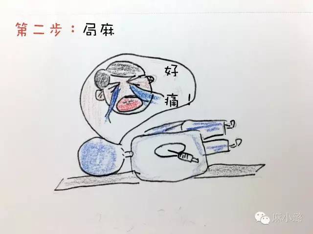 第三步:腰麻