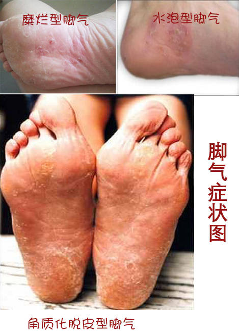 2, 水泡型脚气:病灶多在脚掌缘部,水泡鼓起,奇痒,刺穿流出水后即脱皮