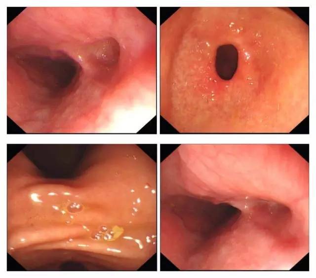 胃镜做了那么多,胃憩室见过几回?