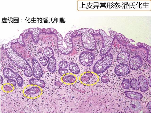 一文读懂|溃疡性结肠炎病理特征性改变