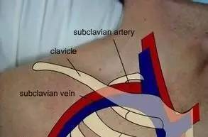 细说锁骨下静脉穿刺置管术