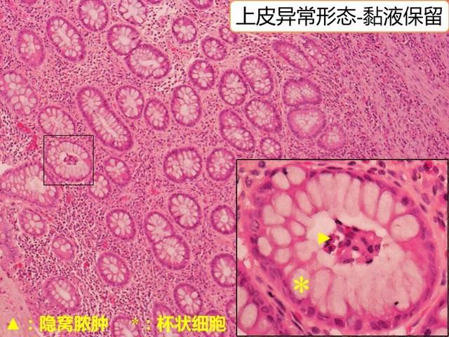 一文读懂|溃疡性结肠炎病理特征性改变