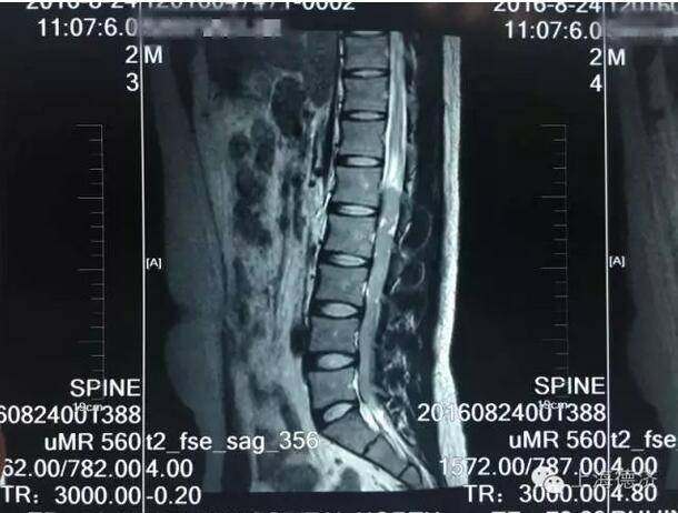 患者27岁,腰骶疼痛1年,具体表现为异常姿势睡觉后感觉骶尾部酸痛