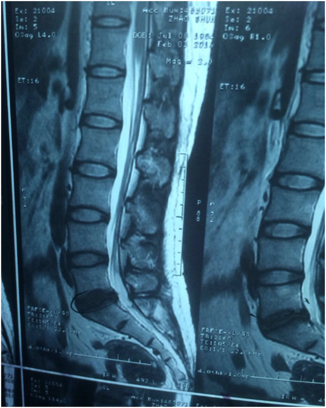 亚专业组负责人晏怡教授主讲的【微·义诊】第二期"腰椎间盘突出