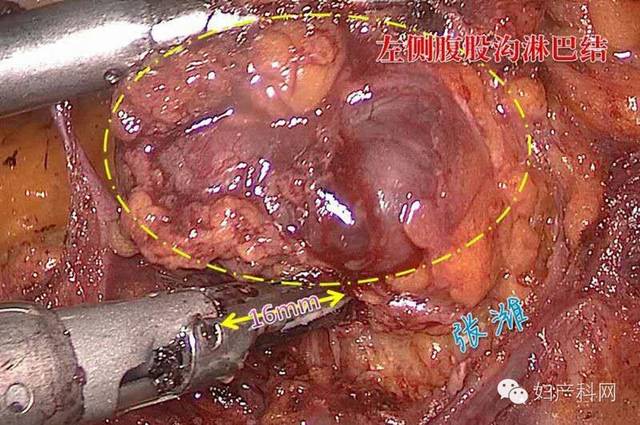 【病例分享】腹腔镜下晚期外阴癌根治术