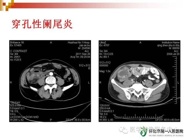 急性阑尾炎的ct诊断,简单易懂!