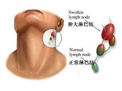 淋巴结肿大应对措施：专家建议与处理方法
