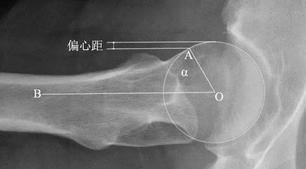 股骨髋臼撞击症:骨科医生应该了解的 x 线表现