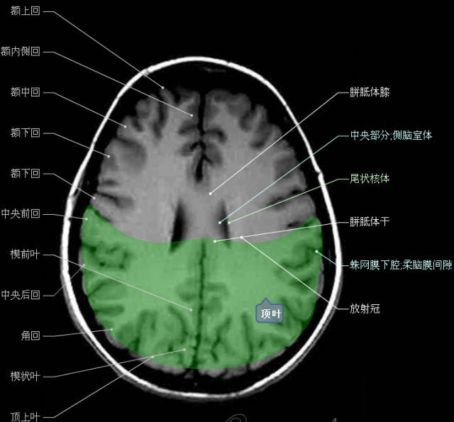 大集合!颅脑轴向结构解剖图
