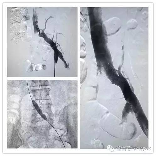 原来她不仅仅是静脉曲张——中日医院完成全国首例髂股静脉专用支架