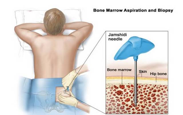 穿刺内衣_骨髓穿刺图片(2)