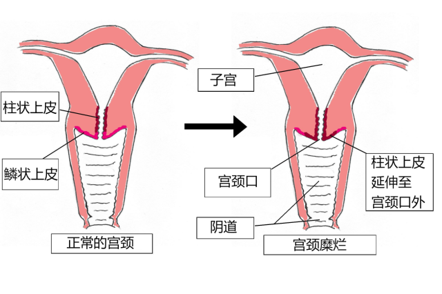 宫颈糜烂不是病,压根儿不用治!