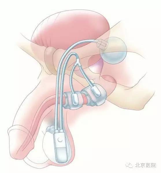 北京医院泌尿外科成功举办人工尿道括约肌全国精品学习班