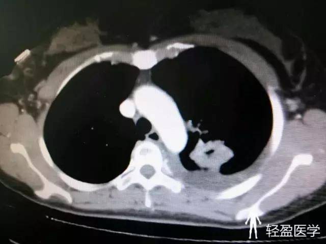 36岁女性,胸闷、气紧1周,诊断:周围型肺癌!