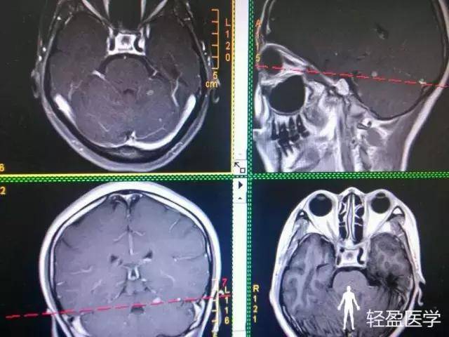 36岁女性,胸闷、气紧1周,诊断:周围型肺癌!