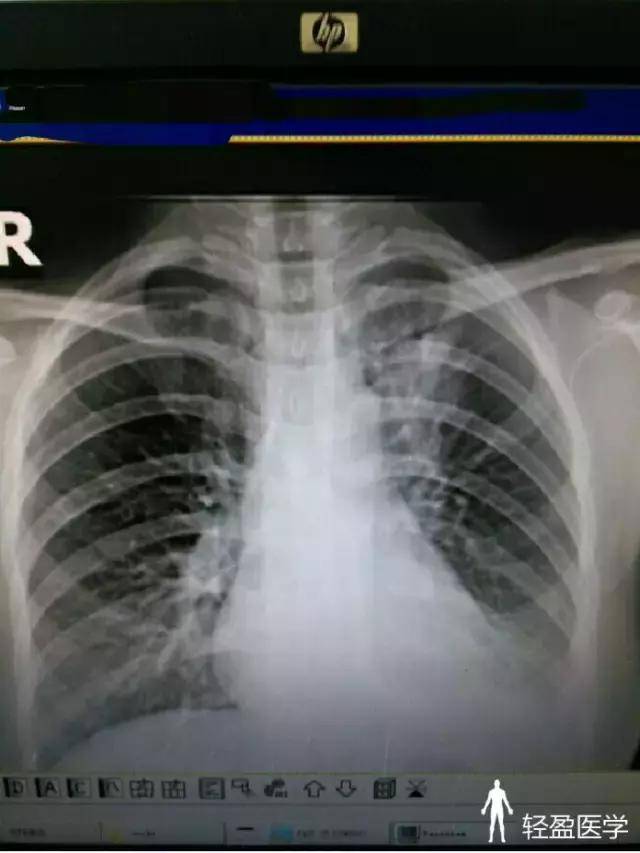 36岁女性,胸闷、气紧1周,诊断:周围型肺癌!