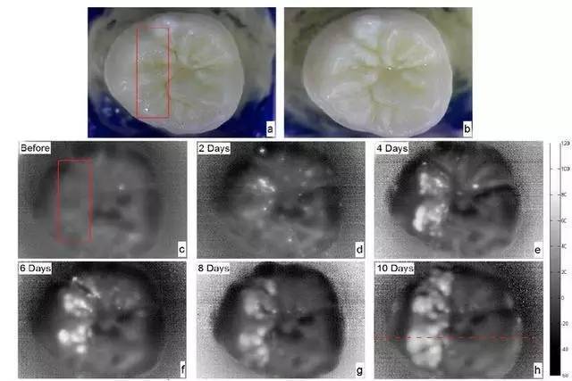【涨姿势】红外线相机助力早期龋齿检测?